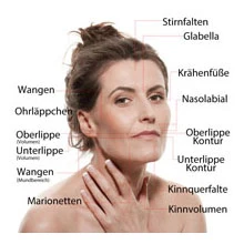 Gesicht mit beschrifteten Behandlungszonen für Hyaluron