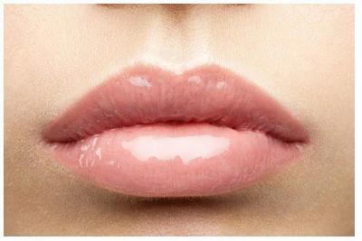 Natürlich volle, klar konturierte Lippen nach Hyaluron-Unterspritzung